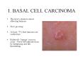1. BASAL CELL CARCINOMA The most common cancer affecting PowerPoint PPT Presentation
