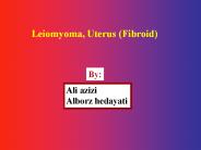 Leiomyoma, Uterus (Fibroid)