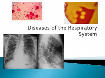 Diseases of the Respiratory System