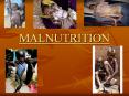 MALNUTRITION PowerPoint PPT Presentation