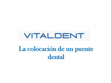 Vitaldent y los puentes dentales