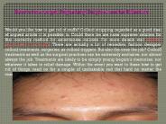Here's how to get Regarding Surgical marks Effective