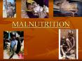 MALNUTRITION PowerPoint PPT Presentation