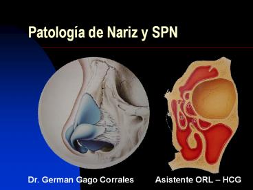 Patologнa de Nariz y SPN