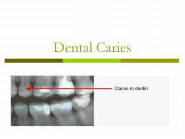 Dental Caries