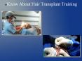 Know about hair transplant PowerPoint PPT Presentation