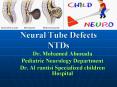 Neural Tube Defects NTDs PowerPoint PPT Presentation