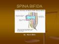 SPINA BIFIDA By: Adam Bibbs Outline for Presentation Lif PowerPoint PPT Presentation