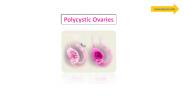 Polycystic Ovarian Syndrome - PCOS