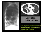Loculated Pneumothorax
