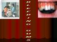BLEEDING GUMS PowerPoint PPT Presentation