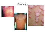 Psoriasis