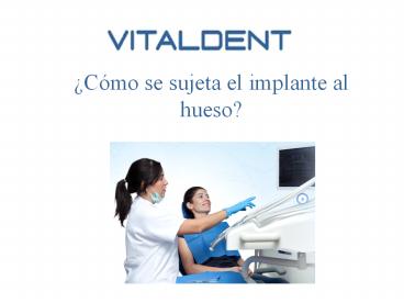 ¿Cómo se sujeta el Implantes Vitaldent al hueso?