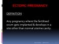 ECTOPIC PREGNANCY PowerPoint PPT Presentation