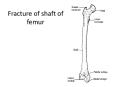 Fracture of shaft of femur PowerPoint PPT Presentation