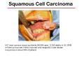 Squamous Cell Carcinoma PowerPoint PPT Presentation