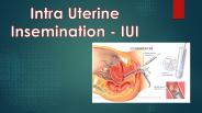 Intra Uterine Insemination - IUI