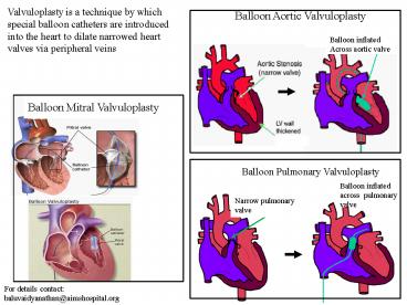Pulmonic Stenosis