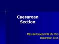 Caesarean Section PowerPoint PPT Presentation