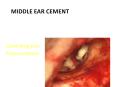 Middle Ear Cement PowerPoint PPT Presentation