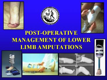POST-OPERATIVE MANAGEMENT OF LOWER LIMB AMPUTATIONS