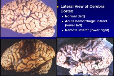 Lateral View of Cerebral Cortex
