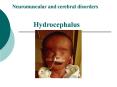 Hydrocephalus PowerPoint PPT Presentation