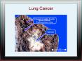 Lung Cancer PowerPoint PPT Presentation