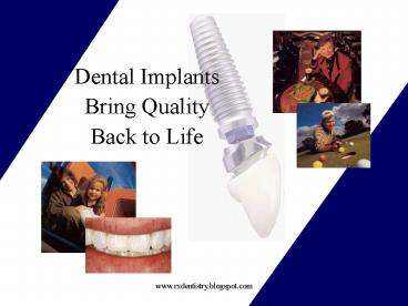 Dental Implants Bring Quality Back to Life