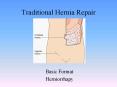 Traditional Hernia Repair PowerPoint PPT Presentation