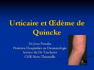 Urticaire et 