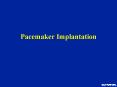 Pacemaker Implantation PowerPoint PPT Presentation
