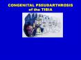 CONGENITAL PSEUDARTHROSIS of the TIBIA PowerPoint PPT Presentation