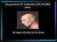 Acupuncture for treatment CVA And Bell palsy PowerPoint PPT Presentation