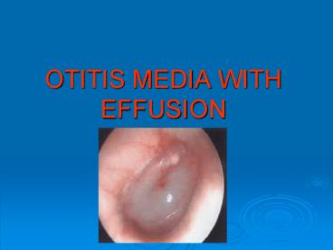 OTITIS MEDIA WITH EFFUSION