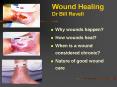 Wound Healing Dr Bill Revell PowerPoint PPT Presentation