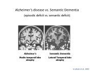 Alzheimer
