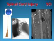 Spinal Cord Injury     SCI