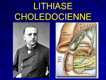 LITHIASE  CHOLEDOCIENNE