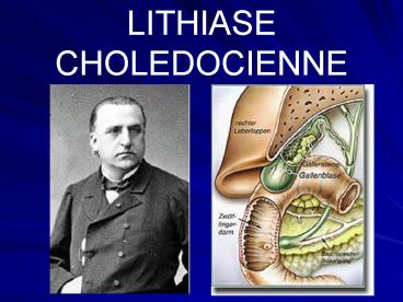 LITHIASE  CHOLEDOCIENNE