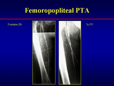 Femoropopliteal PTA