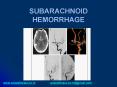 SUBARACHNOID HEMORRHAGE PowerPoint PPT Presentation