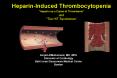 Understanding Heparin-Induced Thrombocytopenia (HIT):  Historical and Clinical Perspectives PowerPoint PPT Presentation