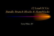 12 Lead ECGs: Bundle Branch Blocks
