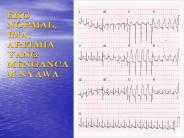 EKG NORMAL, IMA, ARITMIA YANG MENGANCAM NYAWA