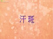 ??(Tinea versicolor) ?????????,??????????????,????????????,??????????????????,????????????,??????????,?????????????????????,??????????????????????,?????????????????? ???????? ?