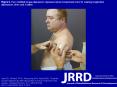 Alley RD, Williams TW III, Albuquerque MJ, Altobelli DE. Prosthetic sockets stabilized by alternating areas of tissue compression and release. J Rehabil Res Dev. 2011; 48(6):679-96. DOI:10.1682/JRRD.2009.12.0197 PowerPoint PPT Presentation