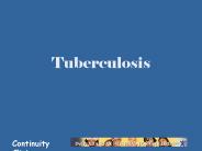 Tuberculosis