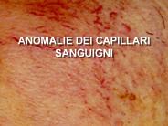 ANOMALIE DEI CAPILLARI SANGUIGNI
