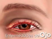 Enfermedades delOjo